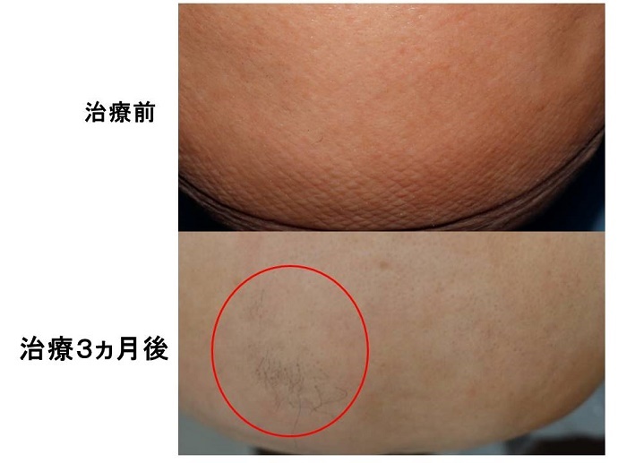 円形脱毛症　病院